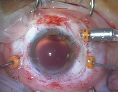 Preparazione per chirurgia vitreoretinica mininvasiva complessa