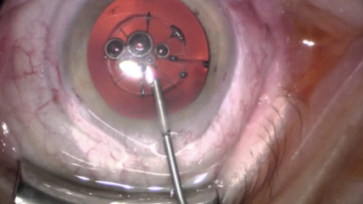 Chirurgia cataratta con Femtolaser oculista cillino